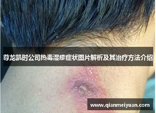 尊龙凯时公司热毒湿疹症状图片解析及其治疗方法介绍